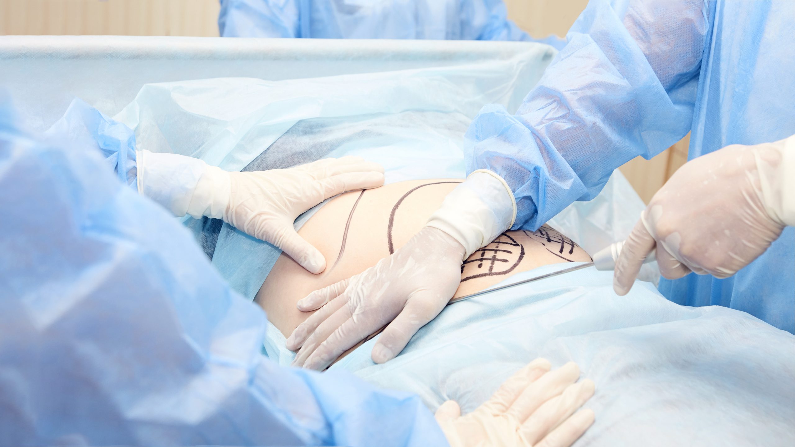 cirugia-pared-abdominal